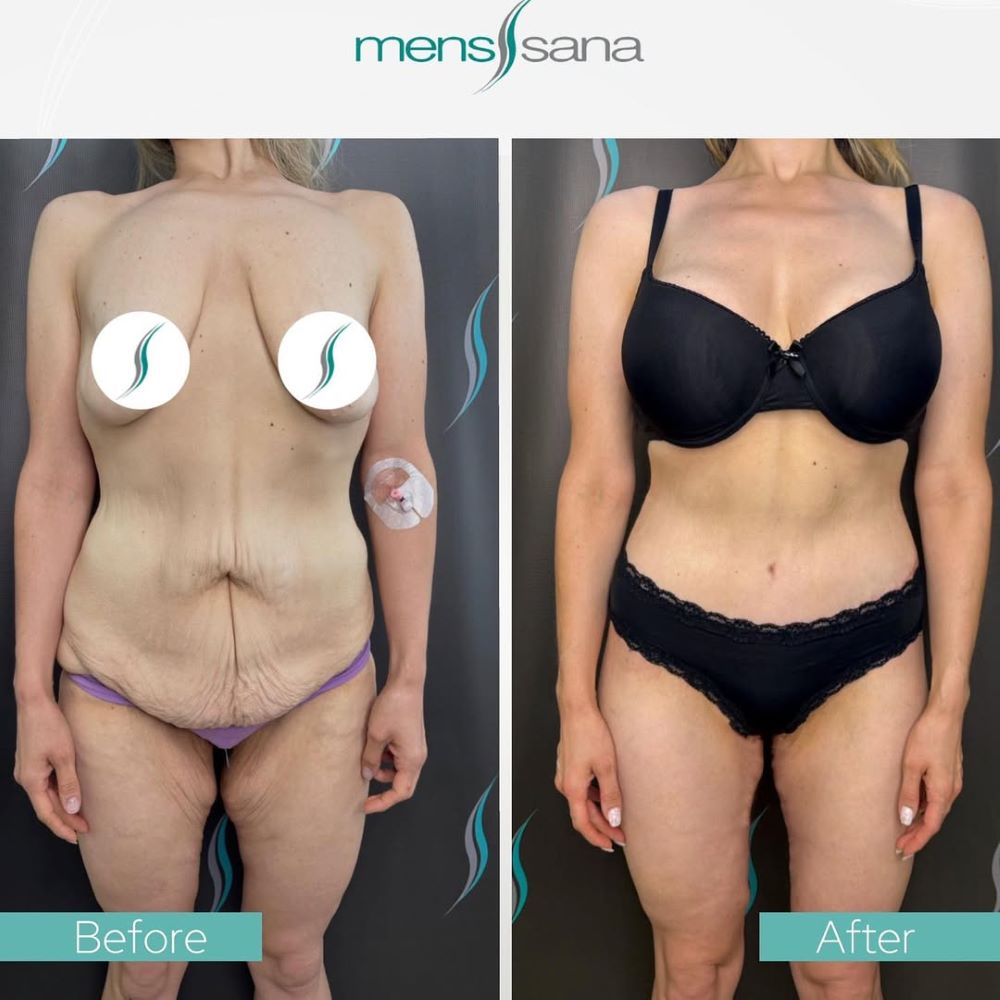 Prvi put na našim prostorima - Total Body Lift